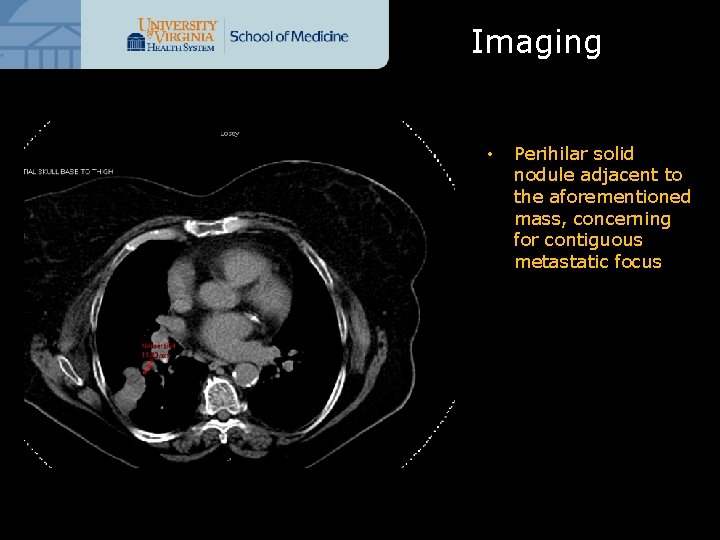 Imaging • Perihilar solid nodule adjacent to the aforementioned mass, concerning for contiguous metastatic