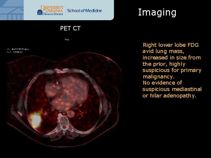 Imaging PET CT Right lower lobe FDG avid lung mass, increased in size from