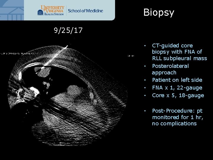 Biopsy 9/25/17 • • • CT-guided core biopsy with FNA of RLL subpleural mass