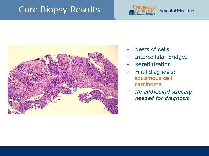 Core Biopsy Results • • • Nests of cells Intercellular bridges Keratinization Final diagnosis: