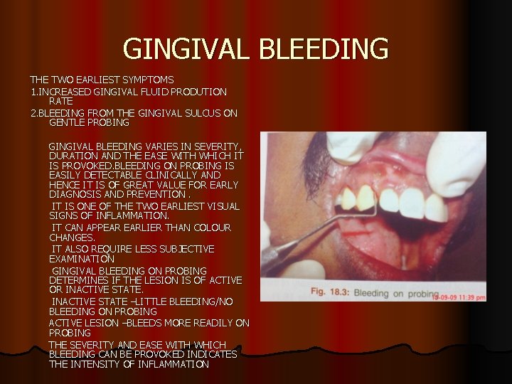 GINGIVAL BLEEDING THE TWO EARLIEST SYMPTOMS 1. INCREASED GINGIVAL FLUID PRODUTION RATE 2. BLEEDING