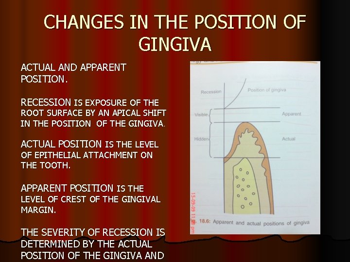 CHANGES IN THE POSITION OF GINGIVA ACTUAL AND APPARENT POSITION. RECESSION IS EXPOSURE OF