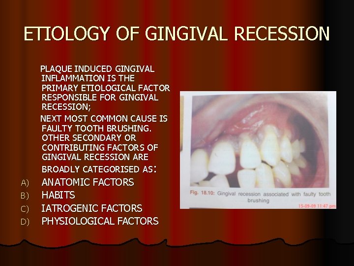 ETIOLOGY OF GINGIVAL RECESSION PLAQUE INDUCED GINGIVAL INFLAMMATION IS THE PRIMARY ETIOLOGICAL FACTOR RESPONSIBLE