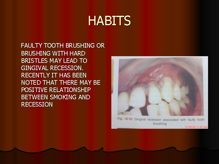 HABITS FAULTY TOOTH BRUSHING OR BRUSHING WITH HARD BRISTLES MAY LEAD TO GINGIVAL RECESSION.