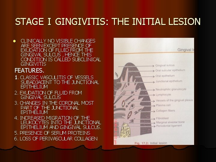 STAGE I GINGIVITIS: THE INITIAL LESION l CLINICALLY NO VISIBLE CHANGES ARE SEEN EXCEPT