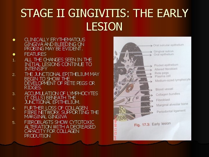 STAGE II GINGIVITIS: THE EARLY LESION l l 1. 2. 3. 4. 5. CLINICALLY