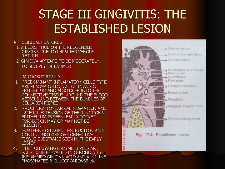 STAGE III GINGIVITIS: THE ESTABLISHED LESION CLINICAL FEATURES 1. A BLUISH HUE ON THE