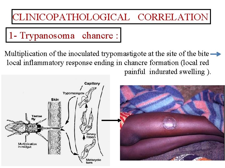 CLINICOPATHOLOGICAL CORRELATION 1 - Trypanosoma chancre : Multiplication of the inoculated trypomastigote at the