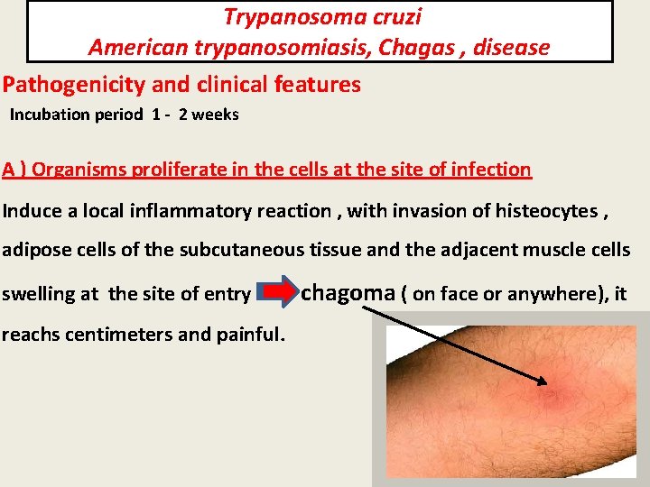 Trypanosoma cruzi American trypanosomiasis, Chagas , disease Pathogenicity and clinical features Incubation period 1