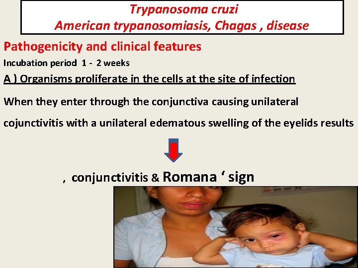 Trypanosoma cruzi American trypanosomiasis, Chagas , disease Pathogenicity and clinical features Incubation period 1