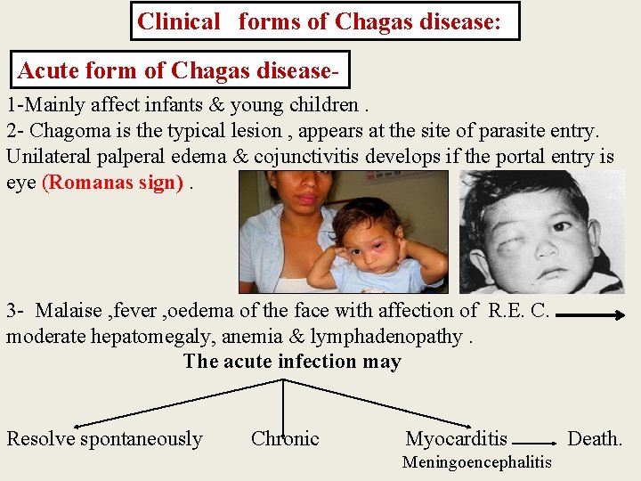 Clinical forms of Chagas disease: Acute form of Chagas disease 1 -Mainly affect infants