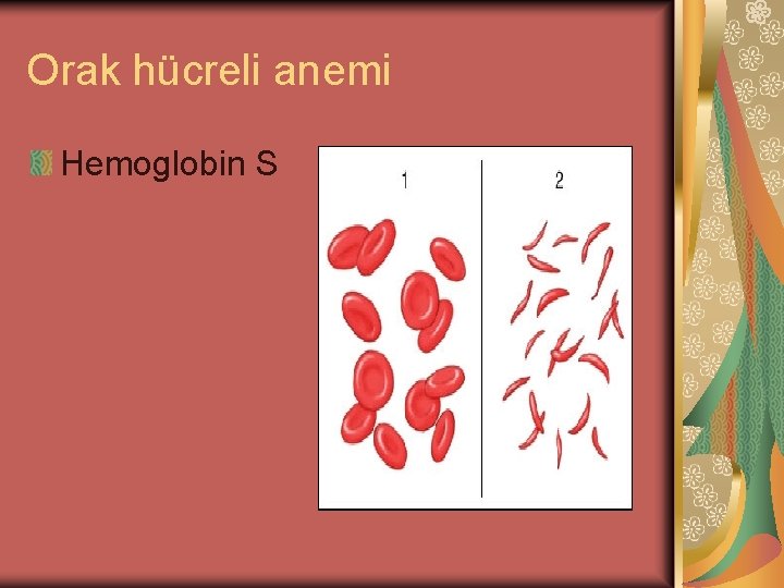 Orak hücreli anemi Hemoglobin S 