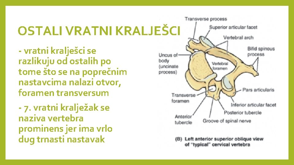OSTALI VRATNI KRALJEŠCI - vratni kralješci se razlikuju od ostalih po tome što se OSTALI VRATNI KRALJEŠCI - vratni kralješci se razlikuju od ostalih po tome što se