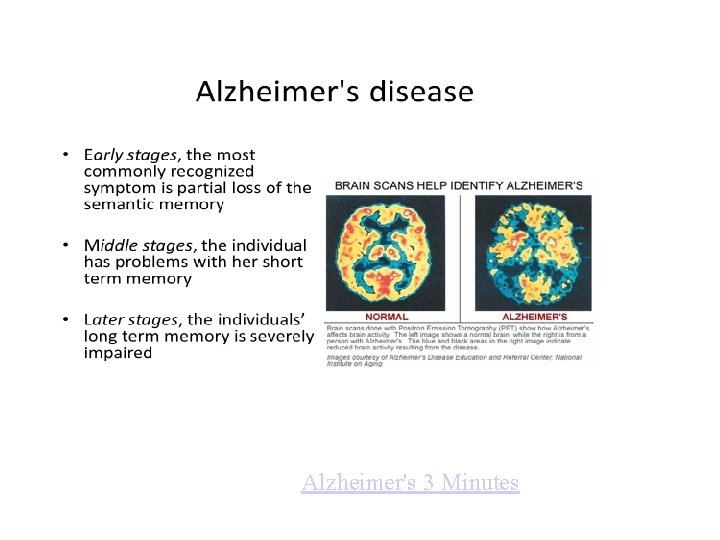 Alzheimer's 3 Minutes 