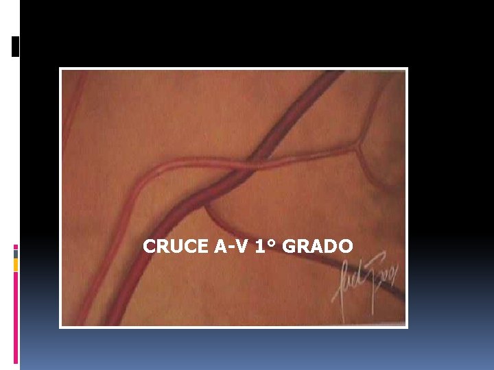 CRUCE A-V 1° GRADO 