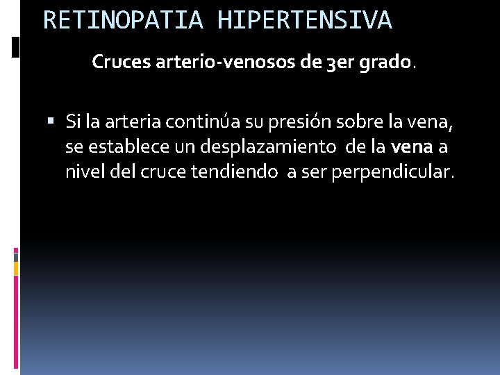 RETINOPATIA HIPERTENSIVA Cruces arterio-venosos de 3 er grado. Si la arteria continúa su presión RETINOPATIA HIPERTENSIVA Cruces arterio-venosos de 3 er grado. Si la arteria continúa su presión