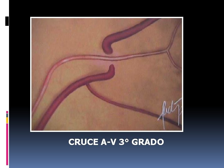 CRUCE A-V 3° GRADO CRUCE A-V 3° GRADO