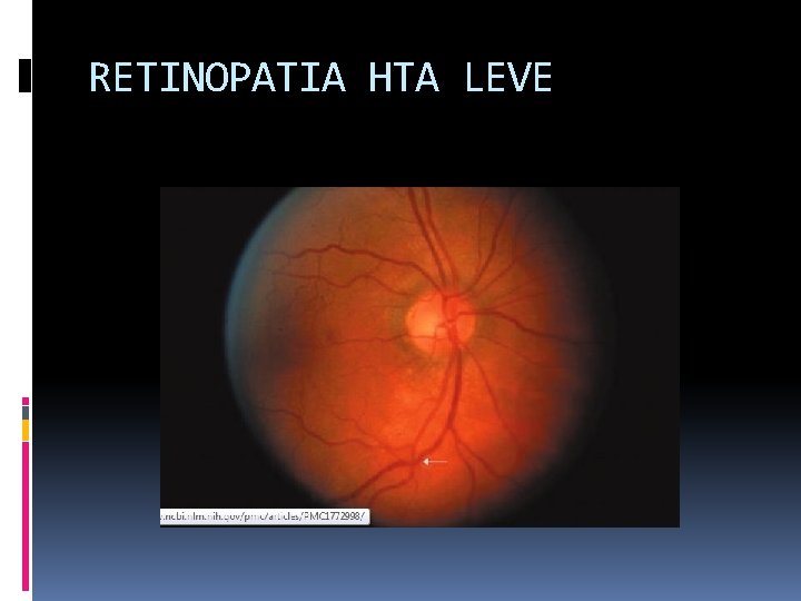 RETINOPATIA HTA LEVE 