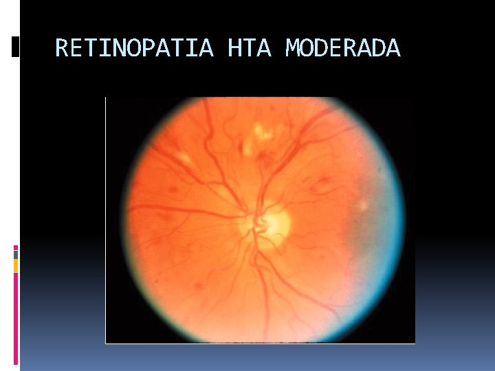 RETINOPATIA HTA MODERADA 