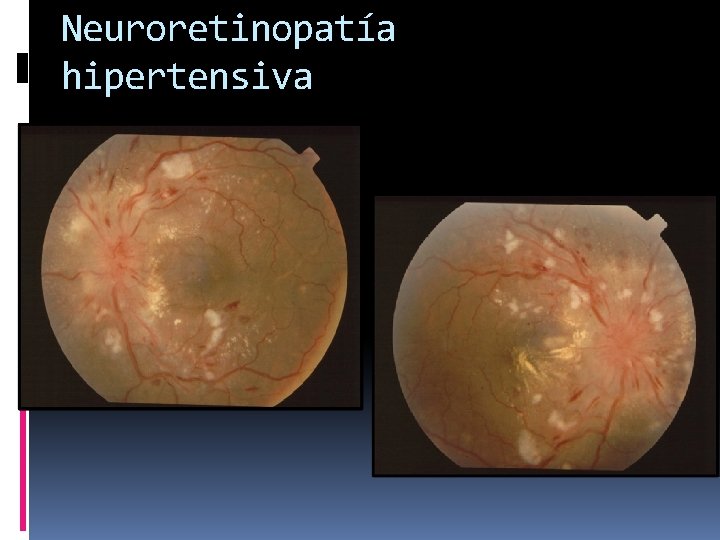 Neuroretinopatía hipertensiva 