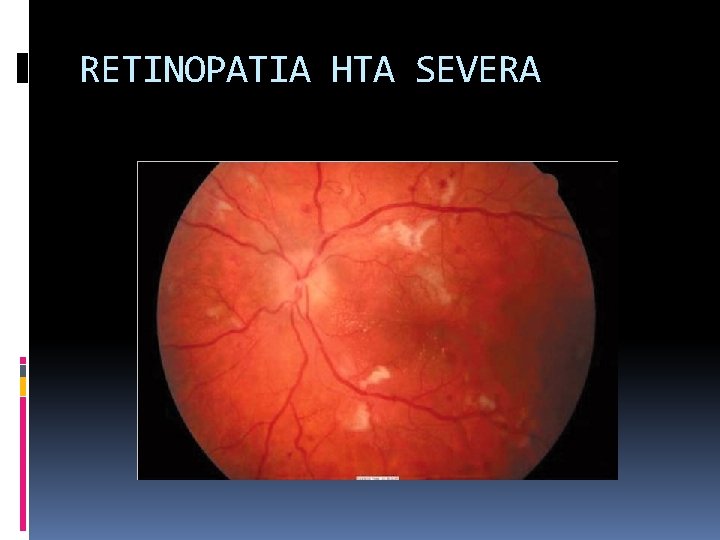 RETINOPATIA HTA SEVERA RETINOPATIA HTA SEVERA