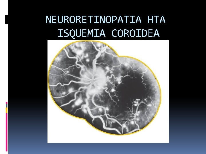 NEURORETINOPATIA HTA ISQUEMIA COROIDEA 