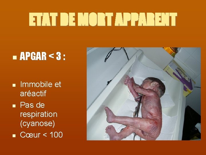 ETAT DE MORT APPARENT APGAR < 3 : Immobile et aréactif Pas de respiration