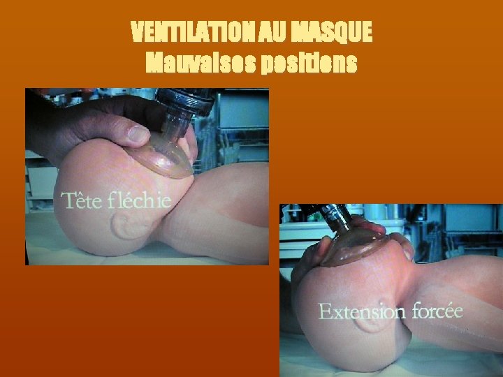 VENTILATION AU MASQUE Mauvaises positions 