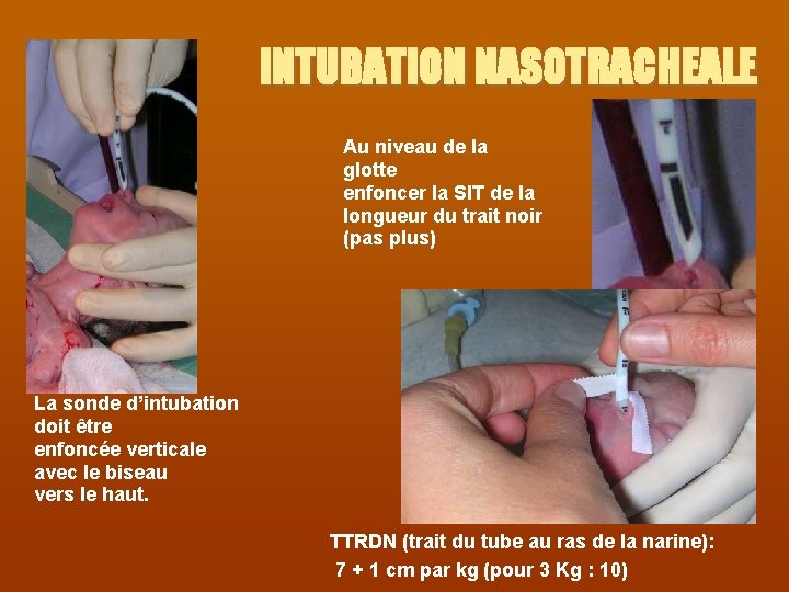 INTUBATION NASOTRACHEALE Au niveau de la glotte enfoncer la SIT de la longueur du