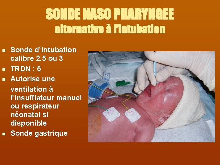 SONDE NASO PHARYNGEE alternative à l’intubation Sonde d’intubation calibre 2. 5 ou 3 TRDN