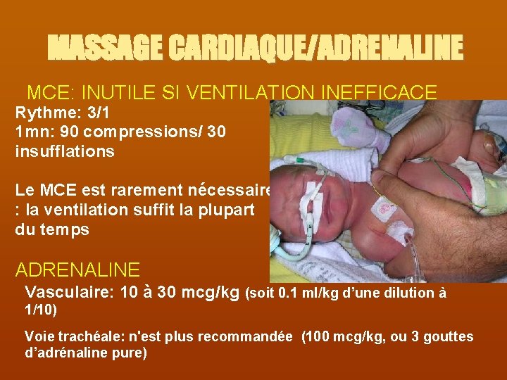 MASSAGE CARDIAQUE/ADRENALINE MCE: INUTILE SI VENTILATION INEFFICACE Rythme: 3/1 1 mn: 90 compressions/ 30