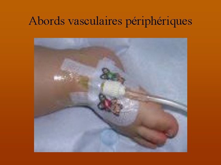 Abords vasculaires périphériques 