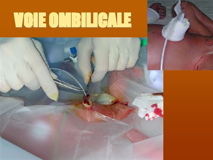 VOIE OMBILICALE 