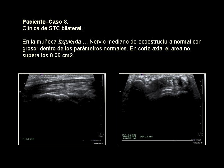 Paciente–Caso 8. Clínica de STC bilateral. En la muñeca izquierda … Nervio mediano de
