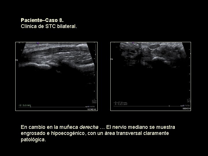 Paciente–Caso 8. Clínica de STC bilateral. En cambio en la muñeca derecha … El