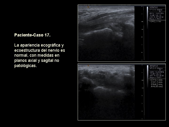Paciente-Caso 17. La apariencia ecográfica y ecoestructura del nervio es normal, con medidas en