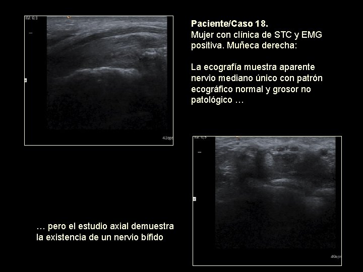 Paciente/Caso 18. Mujer con clínica de STC y EMG positiva. Muñeca derecha: La ecografía