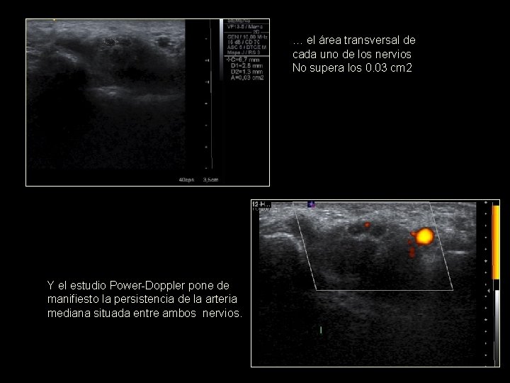 … el área transversal de cada uno de los nervios No supera los 0.