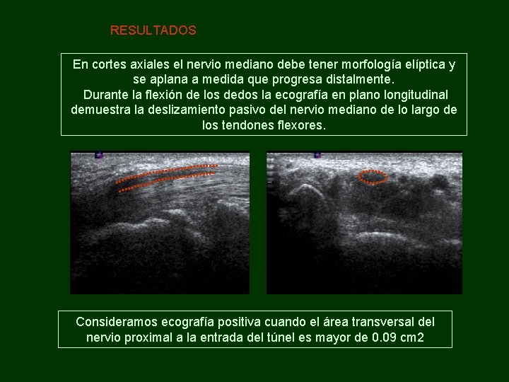 RESULTADOS En cortes axiales el nervio mediano debe tener morfología elíptica y se aplana