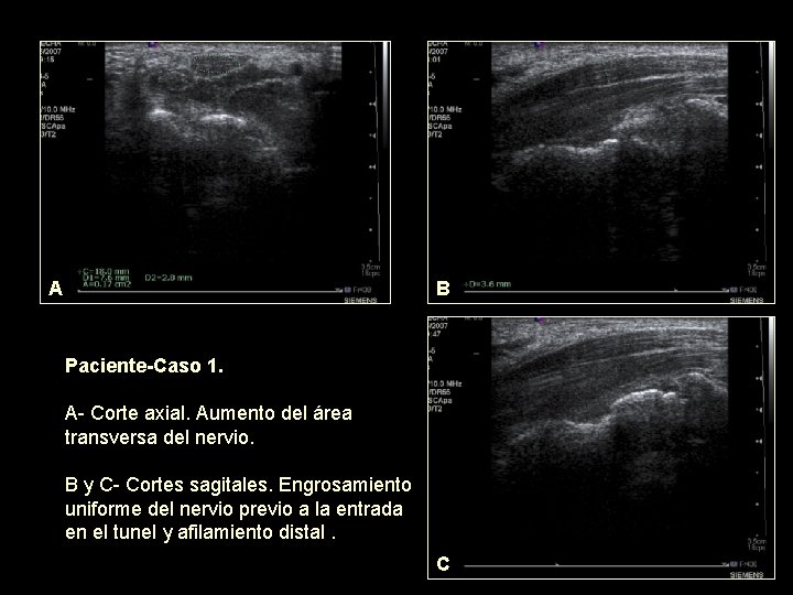 A B Paciente-Caso 1. A- Corte axial. Aumento del área transversa del nervio. B