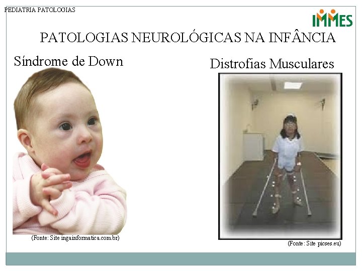 PEDIATRIA PATOLOGIAS NEUROLÓGICAS NA INF NCIA Síndrome de Down (Fonte: Site ingainformatica. com. br)