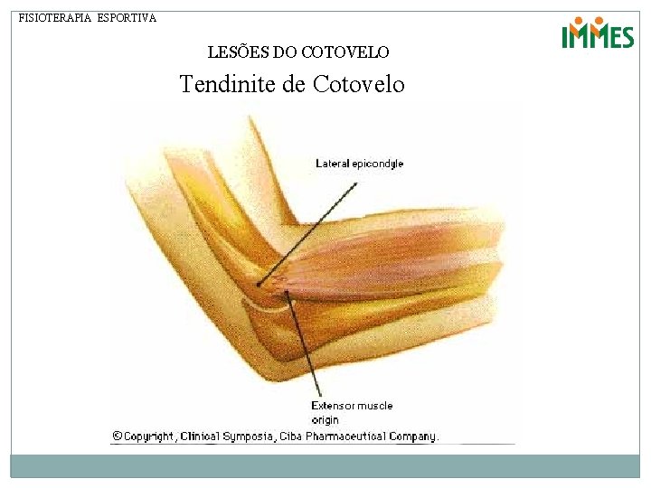 FISIOTERAPIA ESPORTIVA LESÕES DO COTOVELO Tendinite de Cotovelo 