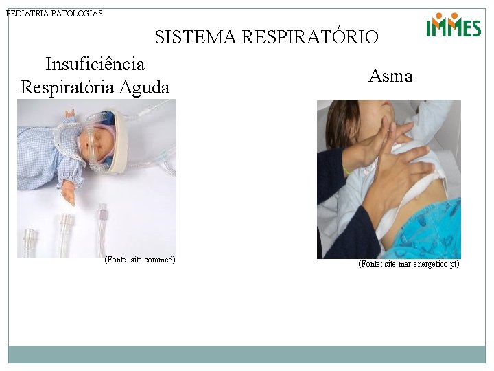 PEDIATRIA PATOLOGIAS SISTEMA RESPIRATÓRIO Insuficiência Respiratória Aguda (Fonte: site coramed) Asma (Fonte: site mar-energetico.