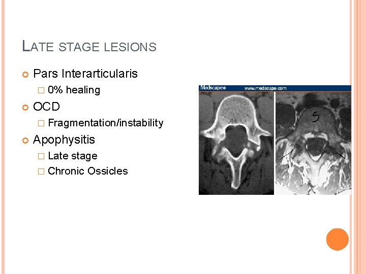 LATE STAGE LESIONS Pars Interarticularis � 0% healing OCD � Fragmentation/instability Apophysitis � Late LATE STAGE LESIONS Pars Interarticularis � 0% healing OCD � Fragmentation/instability Apophysitis � Late