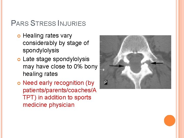 PARS STRESS INJURIES Healing rates vary considerably by stage of spondylolysis Late stage spondylolysis PARS STRESS INJURIES Healing rates vary considerably by stage of spondylolysis Late stage spondylolysis