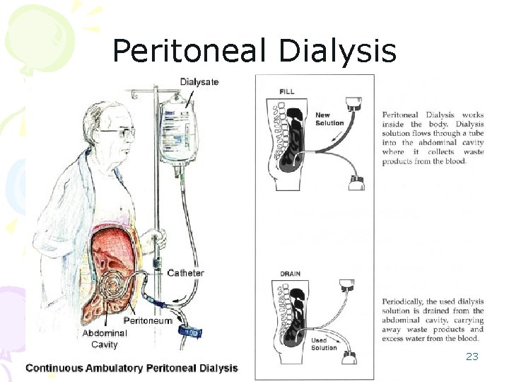 Peritoneal Dialysis 23 