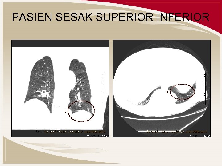 PASIEN SESAK SUPERIOR INFERIOR 