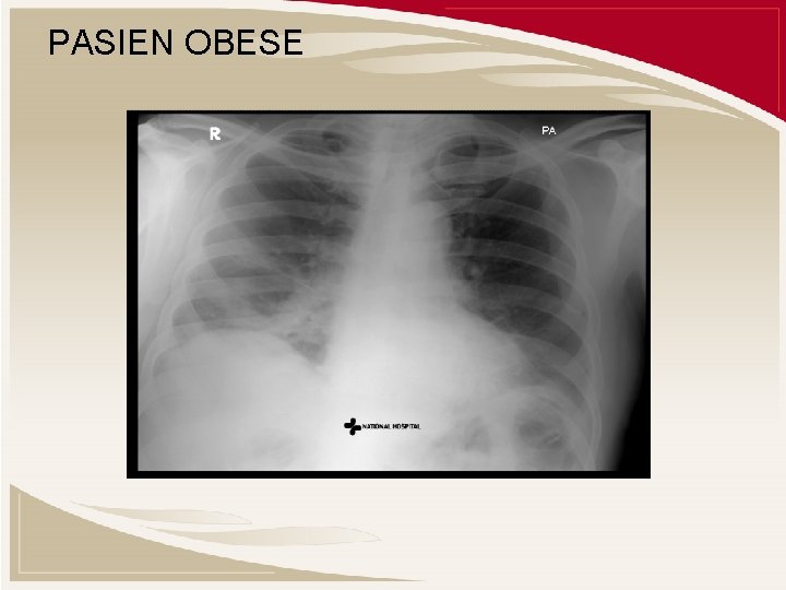 PASIEN OBESE 
