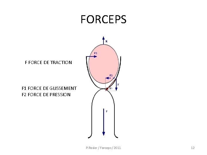 FORCEPS F FORCE DE TRACTION F 1 FORCE DE GLISSEMENT F 2 FORCE DE