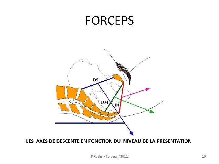 FORCEPS LES AXES DE DESCENTE EN FONCTION DU NIVEAU DE LA PRESENTATION P. Rosier